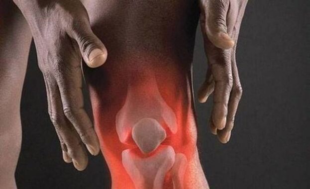 Osteoarthritis is accompanied by an inflammatory process in the knee joint